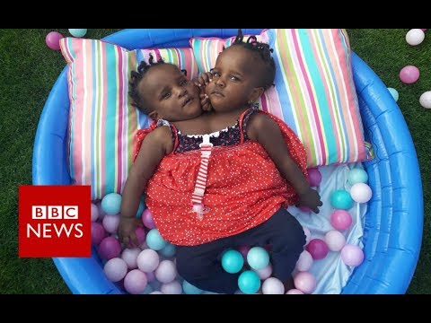 Video - WATCH #Health | What is the Future for these CONJOINED TWINS? - BBC News