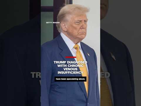 Trump diagnosed with chronic venous insufficiency