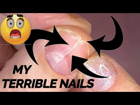 TRYING TO FIX MY TERRIBLE NATURAL NAILS WITH GLITTER ACRYLIC | ABSOLUTE NAILS