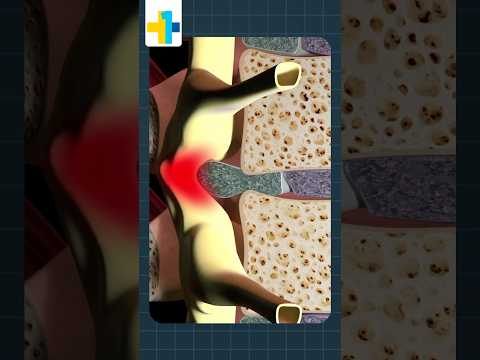 Slip Disc or Disc Bulge? | Dr. Prabaharan, Ortho Surgeon Explains | OneHealth Hospital Vandalur