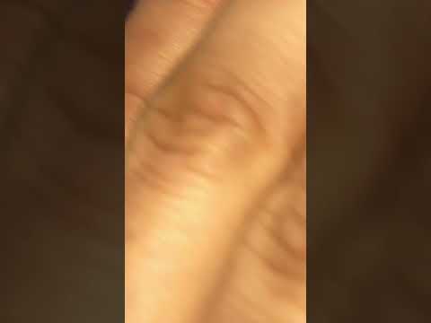 @ingrownhairsatisfying403