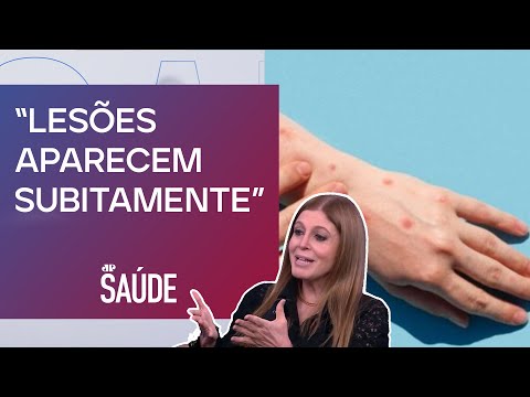 Quais os principais sintomas da Mpox? Infectologista analisa | JP SAÚDE