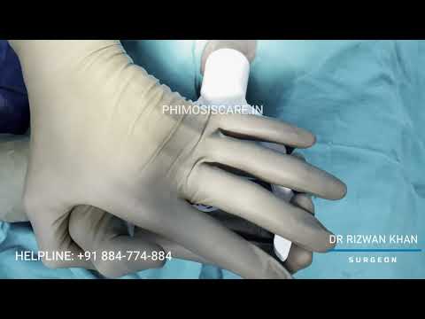 STAPLER Circumcision Surgery | PHIMOSIS | Paraphimosis | Balanitis | ZSR | Alisklamp, Pune.