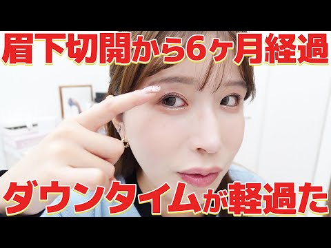 【眉下切開】6ヶ月が経過したのでビフォーアフターや効果を紹介します✨