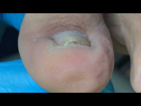 Short toenails, trim the ingrown toenails on both sides【Crazy pedicure room】