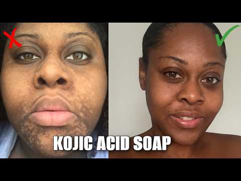 WHY KOJIC ACID SOAP ISN'T WORKING FOR YOU (What no-one is telling you)
