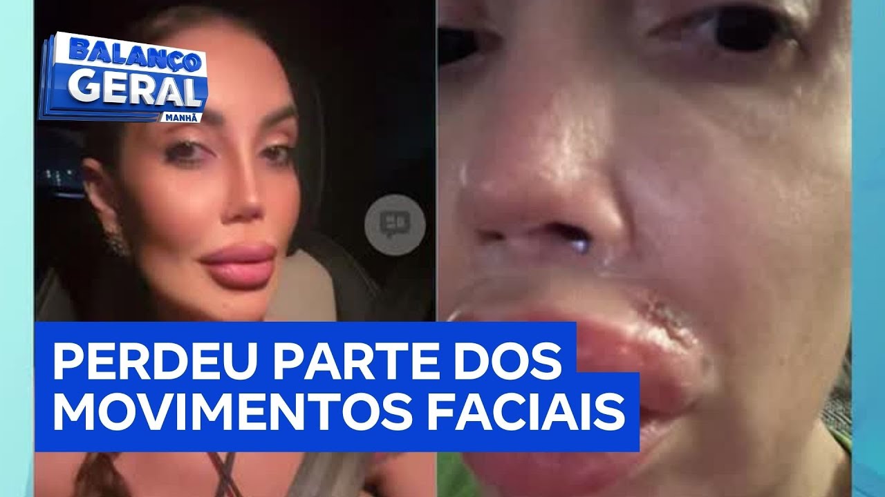 Mulher fica com lábios inchados e dentes quebrados após fazer procedimento estético com dentista TV Online Mulher fica com lábios inchados e dentes quebrados após fazer procedimento estético com dentista