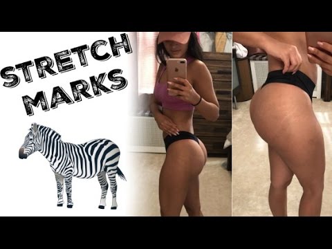 ALL About Stretch Marks!