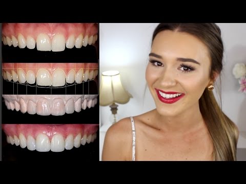 All About My Teeth Transformation #TeethTalk - UCPG6A5tNaPfv2SRNW2beq5Q