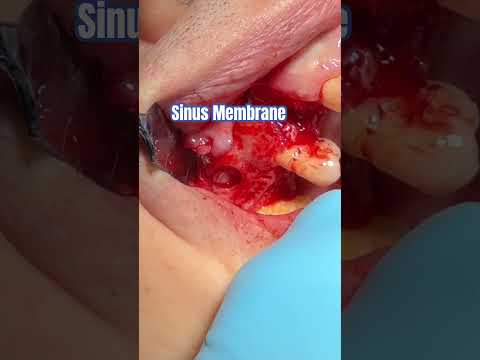Sinus Augmentation #love #life #dentalstudenteducation #motivation #jesus