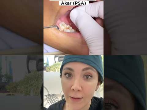 How Does The Nerve Of Your Tooth Look Like?!