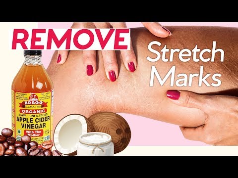 How to Get Rid of Stretch Marks! 7 Natural Ways + 4 Pressure Points - UC8f2CDyLibpGYSN3O2LfDwg