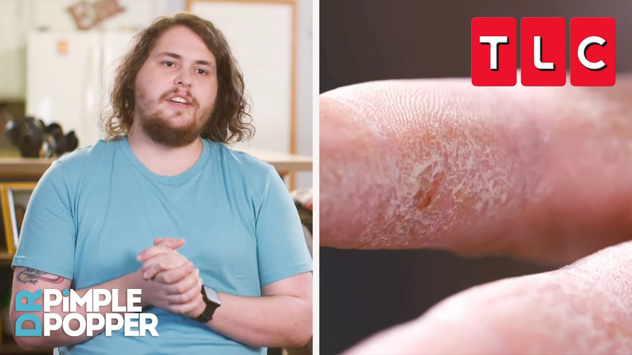 NOTHING Can Help This Man’s Unbearably Dry Skin | Dr. Pimple Popper | TLC
