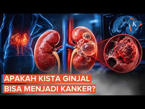 Apakah Kista Ginjal Bisa Menjadi Kanker? Ini Penjelasannya