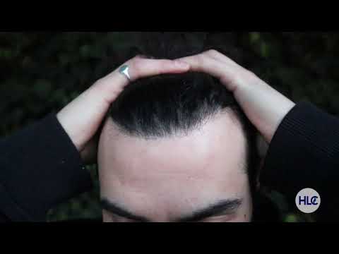 Hair Transplant before and after with 3600 Grafts, Receding hairline