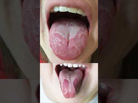 Geographic Tongue, not to fear.. #kannada #geographictongue #patchytongue #kids #parents #childdoc