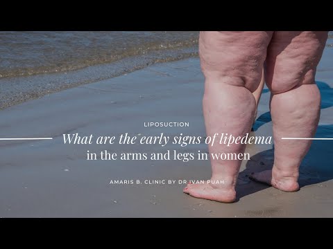 What are the early signs of lipedema in the arms and legs in women | Amaris B. Clinic