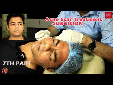 Comparison/Update||Acne Scars Treatment After 5 Sessions/Micro needling/ Subcision|| Pimples Scars