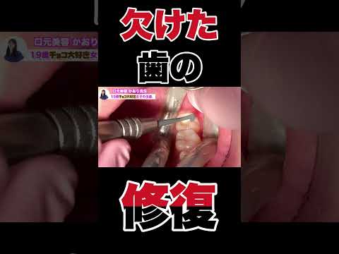 甘いものが好きで歯が欠けちゃったときは？