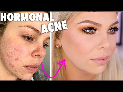 Full Coverage Foundation Routine for Covering Hormonal Acne - UChplUdodMCdfZfmTQbRhNWw