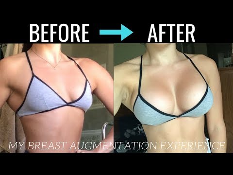 MY BREAST AUGMENTATION EXPERIENCE – Process, Recovery & Details! - UC-07j8SBVA5mHbiNWe2-jcw