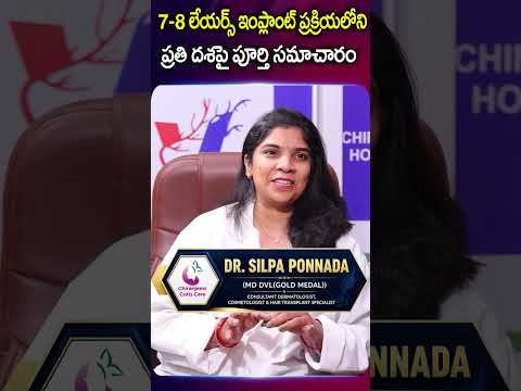 7-8 లేయర్స్ ఇంప్లాంట్ ప్రక్రియలోని ప్రతి దశపై Full Details | Hair Transplant | Dr. SILPA PONNADA