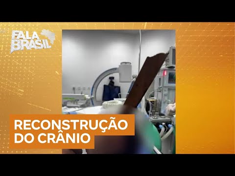 Crânio reconstruído: serralheiro sobrevive após ter estaca de madeira cravada na cabeça