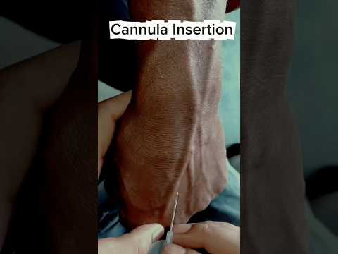 تركيب كانيولا#cannulation