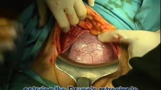 C - section - Cesarean delivery in live (Full)