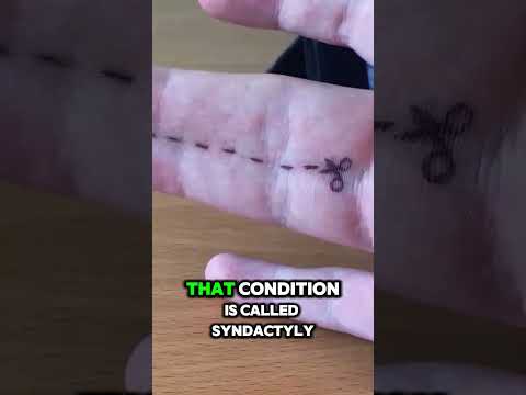 This Rare Condition Called Syndactyly Will Surprise You