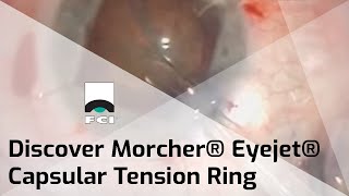 The Inner Circle: Tips for Using the Morcher Ring