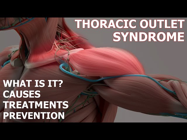 How Thoracic Outlet Syndrome Affects Baseball Players