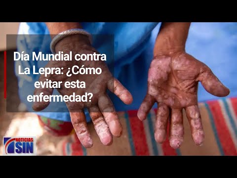 Día Mundial contra La Lepra: ¿Cómo evitar esta enfermedad?