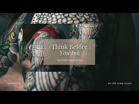 [Tattoo Removal] Think Before You Ink
