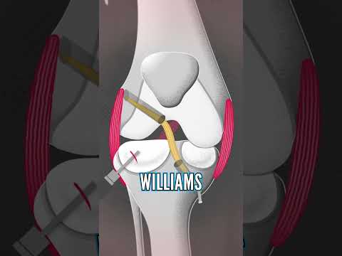 Neil’s Knee Surgery Explained!