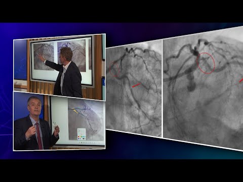 How should I treat ostial left circumflex stenosis? - Webinar