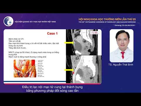 3. Điều trị lạc nội mạc tử cung tại thành bụng bằng đốt sóng cao tần (TS. Nguyễn Thái Bình)
