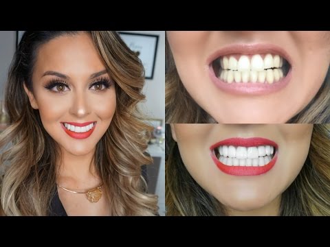 My Teeth Transformation l Veneers Experience - UCXTAdFsBmxNK3_c8MUvSviQ