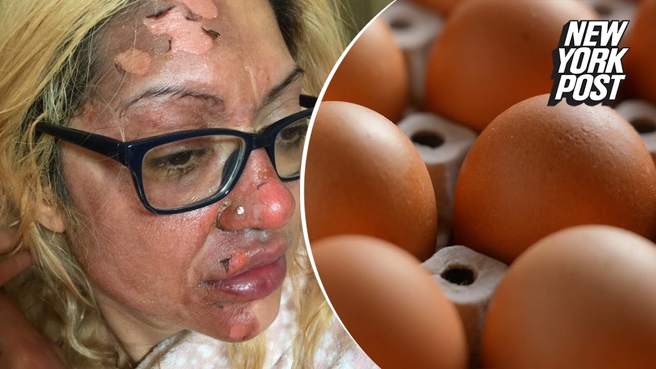 I tried to poach an egg in the microwave — it scorched my face | New York Post