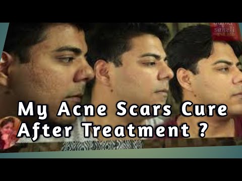 क्या Acne Scar Treatment करवाने से पिम्पल्स के गड्डे भर जाते है ?Conclusion of my AcneScar Treatment
