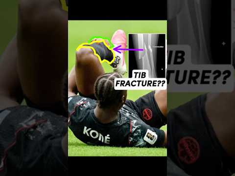 Doctor explains Ismaël Koné’s Gruesome Leg Fracture at World Cup