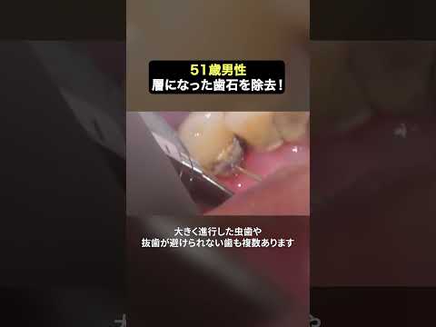 歯石除去だけで歯がグラグラ😢  #ザホワイトデンタルクリニック  #歯医者  #歯石除去