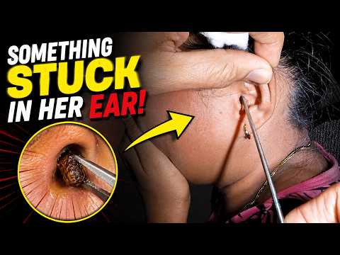 Something CRAWLED & STUCK in Woman's Ear Removed