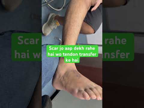 Best Foot drop Treatment / successful recovery after foot drop surgery / Dr Chandan Narang
