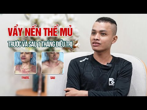 Từ VẨY NẾN THỂ MỦ NẶNG đến NỤ CƯỜI TRỞ LẠI trở: Câu chuyện kỳ diệu sau hơn 1 THÁNG điều trị