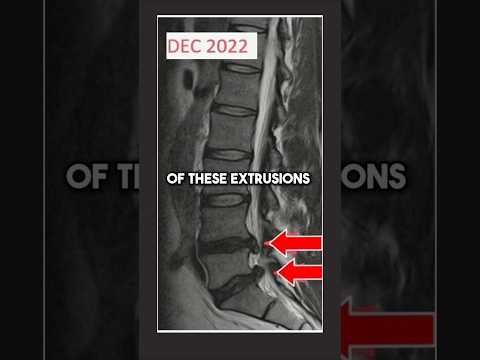 Double Lumbar disc extrusion resorption #discextrusion