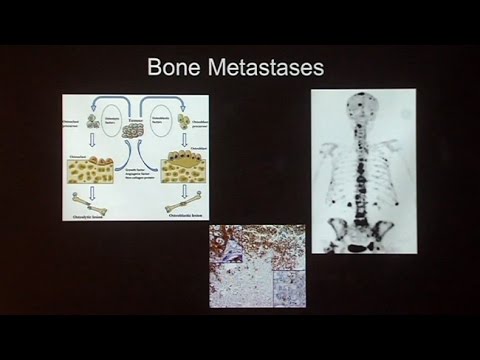 Advanced Prostate Cancer - UCh6KFtW4a4Ozr81GI1cxaBQ