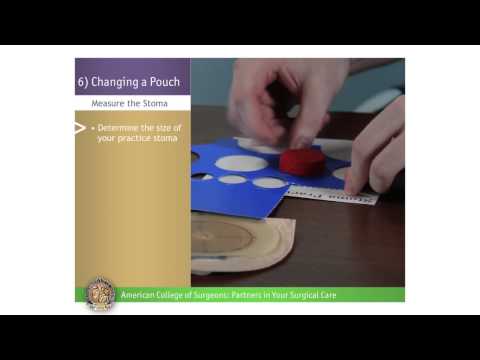 Pediatric Urostomy: Changing a Pouch