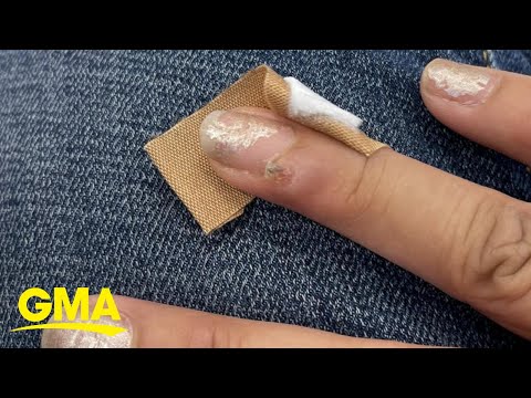 Woman claims she got HPV-related nail cancer after salon visit l GMA