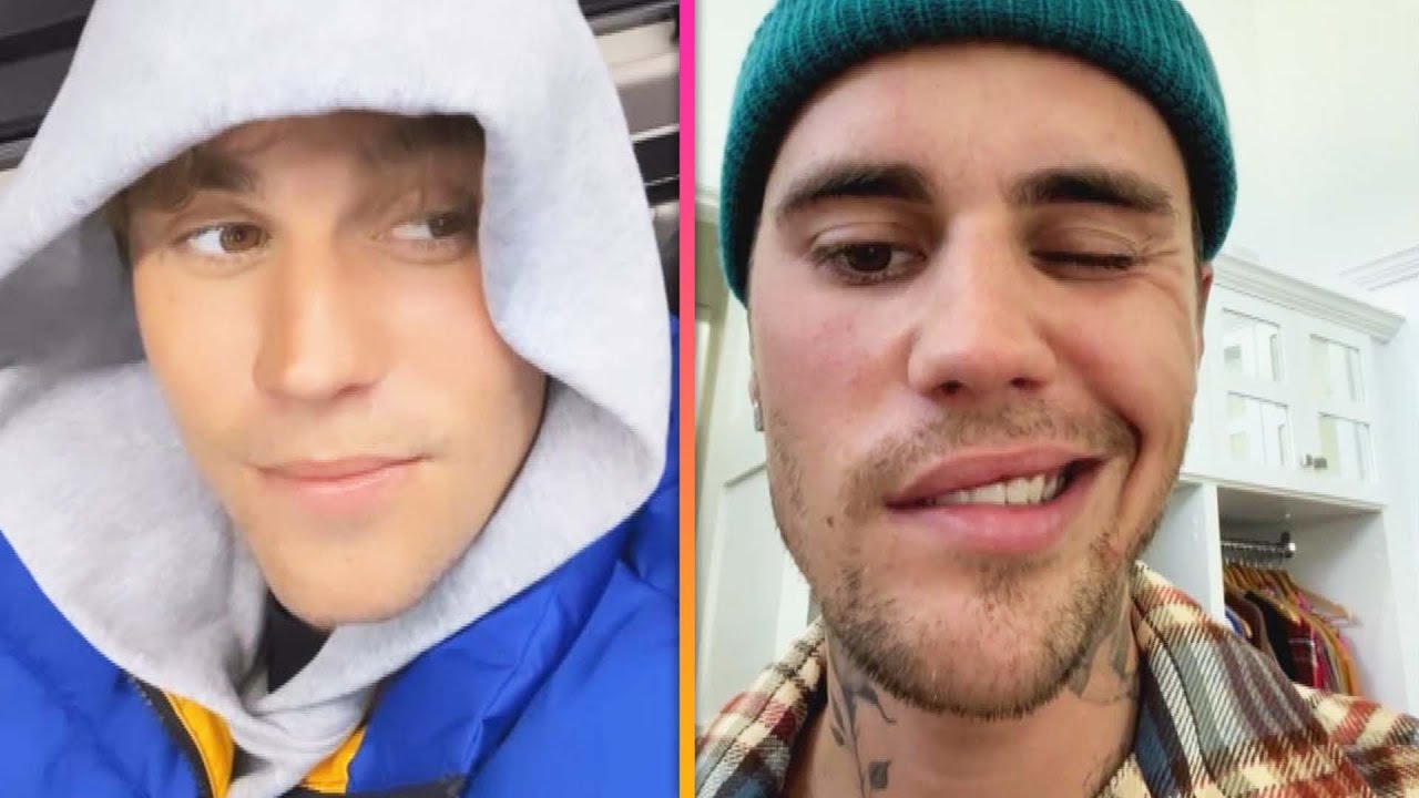 Justin Bieber Shows Off Facial Paralysis Recovery Progress